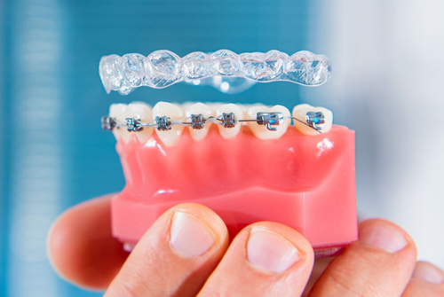 Invisalign San Antonio Texas: Discreet, Comfortable Smile Correction with Amini Ortho.png