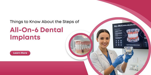 Things to Know About the Steps of All On 6 Dental Implants.jpg