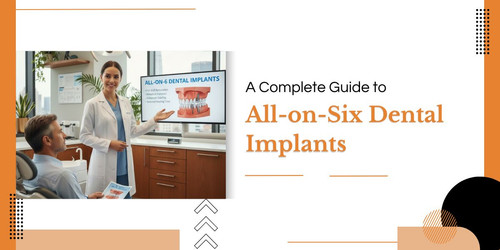 A Complete Guide to All on Six Dental Implants.jpg