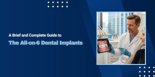 A Brief and Complete Guide to the All on 6 Dental Implants.jpg