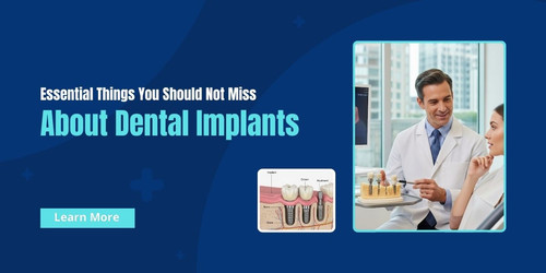Essential Things You Should Not Miss About Dental Implants.jpg