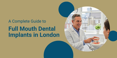 A Complete Guide to Full Mouth Dental Implants in London.jpg