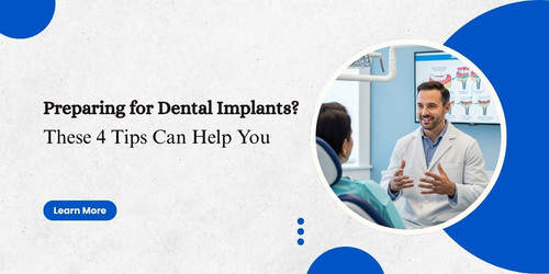 Preparing for Dental Implants These 4 Tips Can Help You.jpg