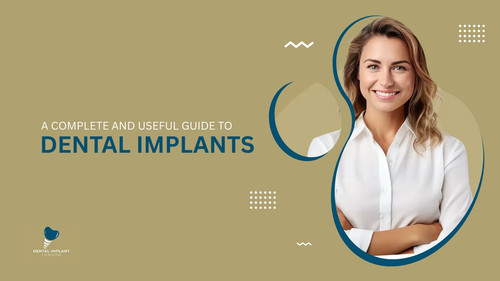 A Complete and Useful Guide to Dental Implants.jpg
