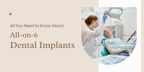 All You Need to Know About All on 6 Dental Implants Copy.jpg