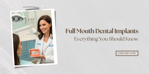 Full Mouth Dental Implants Everything You Should Know Copy.jpg