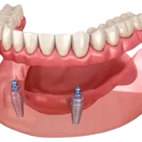 teeth whitening