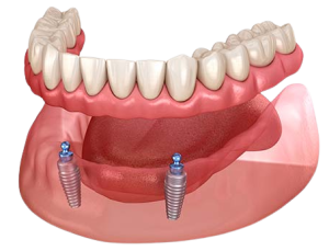 teeth whitening.webp