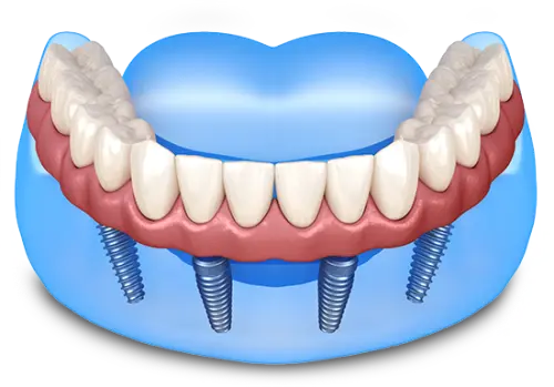 porcelain veneers.webp