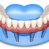 porcelain veneers