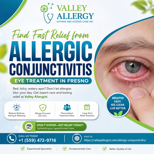 Allergic conjunctivitis eye treatment Fresno.png