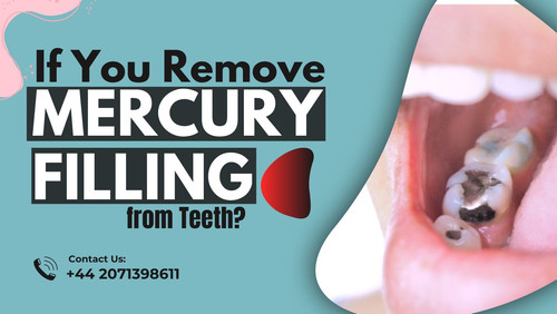 What Happens If You Remove Mercury Filling from Teeth.jpg