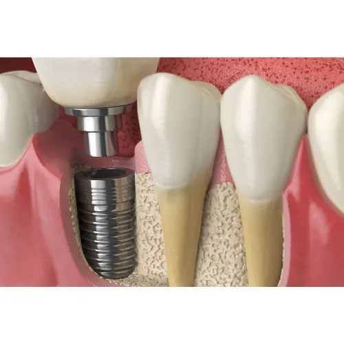 Dental Implants Melbourne.png