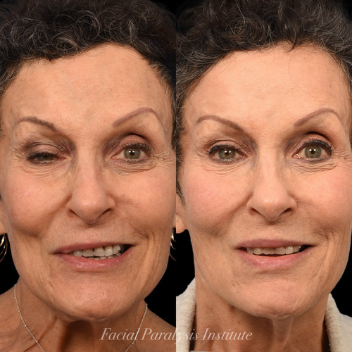 Facial Reanimation Beverly Hills.jpg