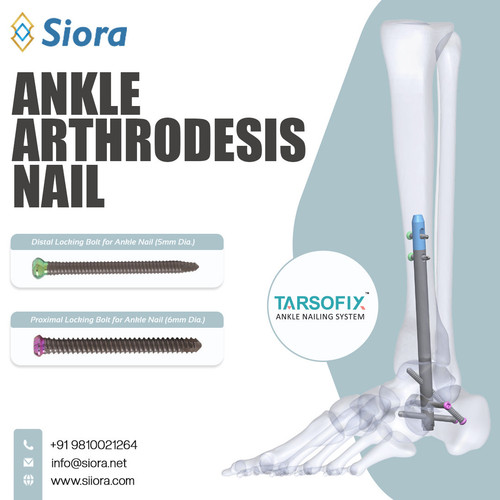 Ankle Arthrodesis Nail.jpg