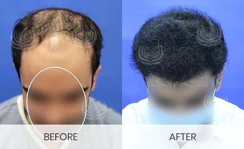 Stage 2 Hair Loss: Early Signs and Treatment Options | MedLinks Hair Transplant.webp