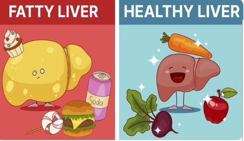 Fatty liver.png