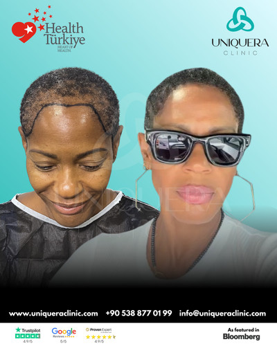 Diffuse Thinning Hair Transplant at UniquEra Clinic Natural Hair Restoration.jpg