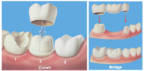 Cosmetic Dentist Fresh Meadows | Bayside Dental Crowns.png
