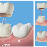 Cosmetic Dentist Fresh Meadows | Bayside Dental Crowns