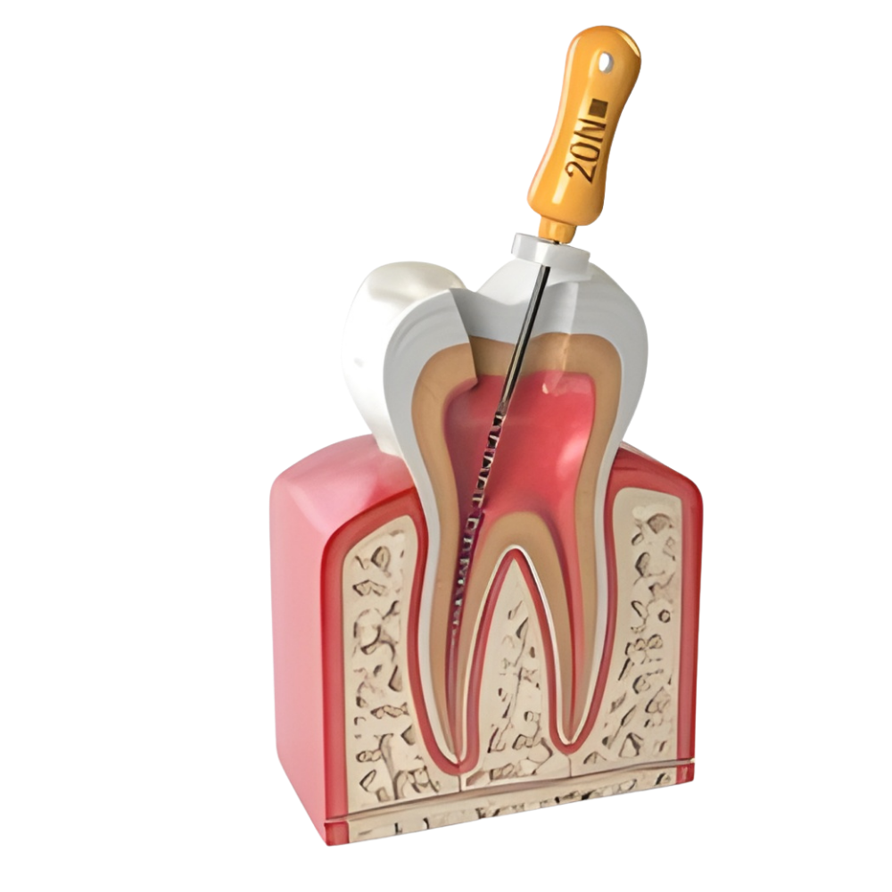 Root Canal Treatment