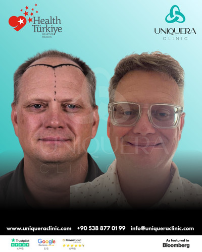 Best Hair Transplant in Turkey for Permanent Natural Results – Uniquera Clinic.jpg