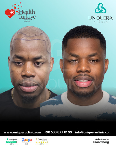 Expert Afro Hair Transplant in Turkey for Natural Results – Uniquera Clinic.jpg