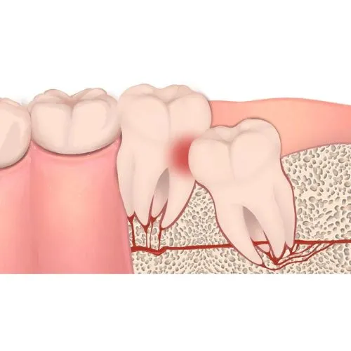 All-On-X Dental Implants Melbourne.png