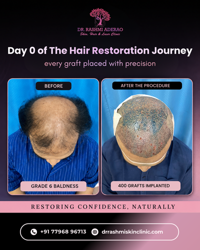 Visit our Skin clinic Karvenagar and consult a trusted Skin specialist Kothrud.png