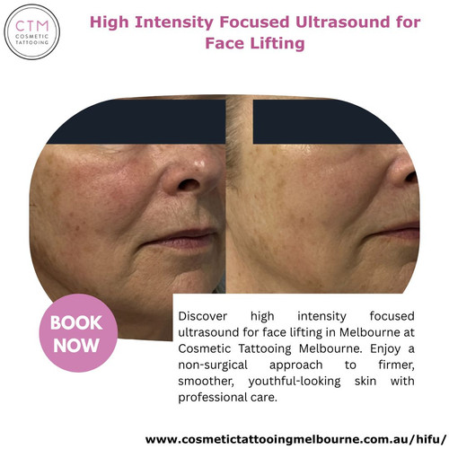 High Intensity Focused Ultrasound for Face Lifting.jpg
