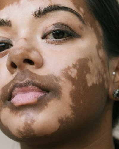 vitiligo beauty photography elisabeth van aalderen 1 5dd3a009ace8e 700.jpg
