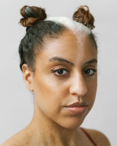 vitiligo beauty photography elisabeth van aalderen 24 5dd3a06033781 700.jpg