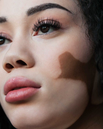 vitiligo beauty photography elisabeth van aalderen 27 5dd3a0699a000 700.jpg
