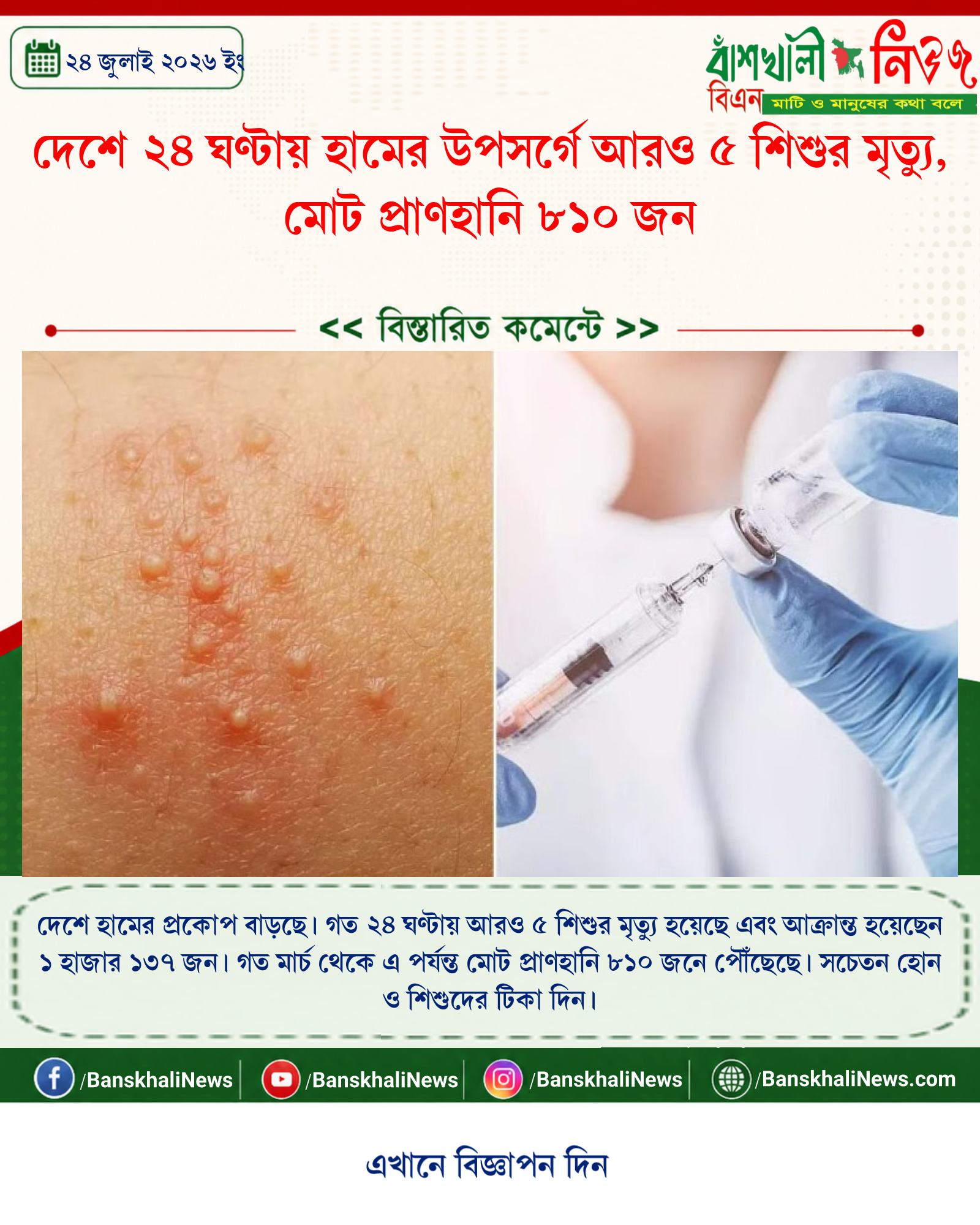 দেশে ২৪ ঘণ্টায় হামের উপসর্গে আরও ৫ শিশুর মৃত্যু, মোট প্রাণহানি ৮১০ জন