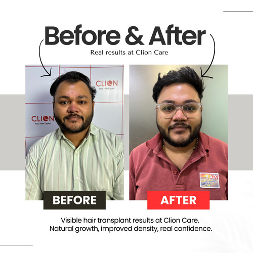 Hair Loss Treatment Vadodara.jpg