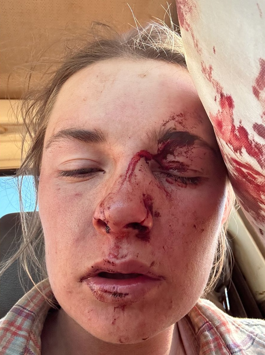 Amy's injuries immediately after she regained consciousness.