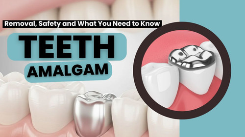 Teeth Amalgam Removal, Safety and What You Need to Know.jpg