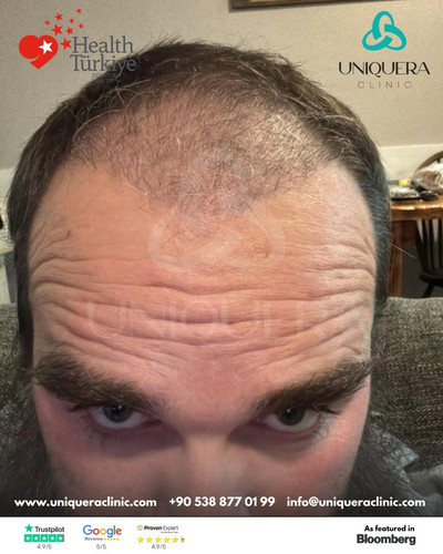 Expert DHI Hair Transplant in Istanbul for Permanent Results – Uniquera Clinic.jpg