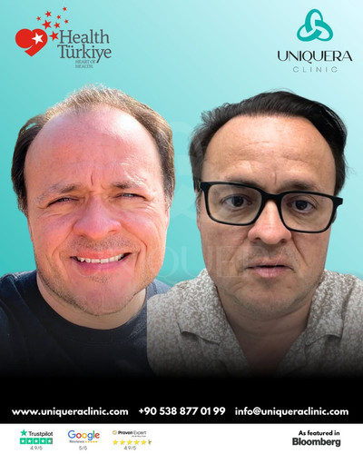 DHI Hair Transplant Before and After Results – Uniquera Clinic Turkey.jpg