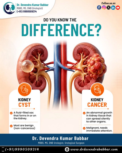 Kidney Cyst vs Kidney Cancer.jpg