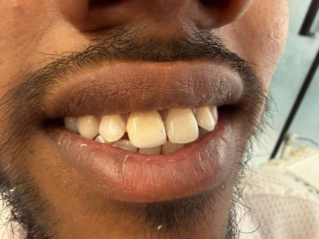 White smile after