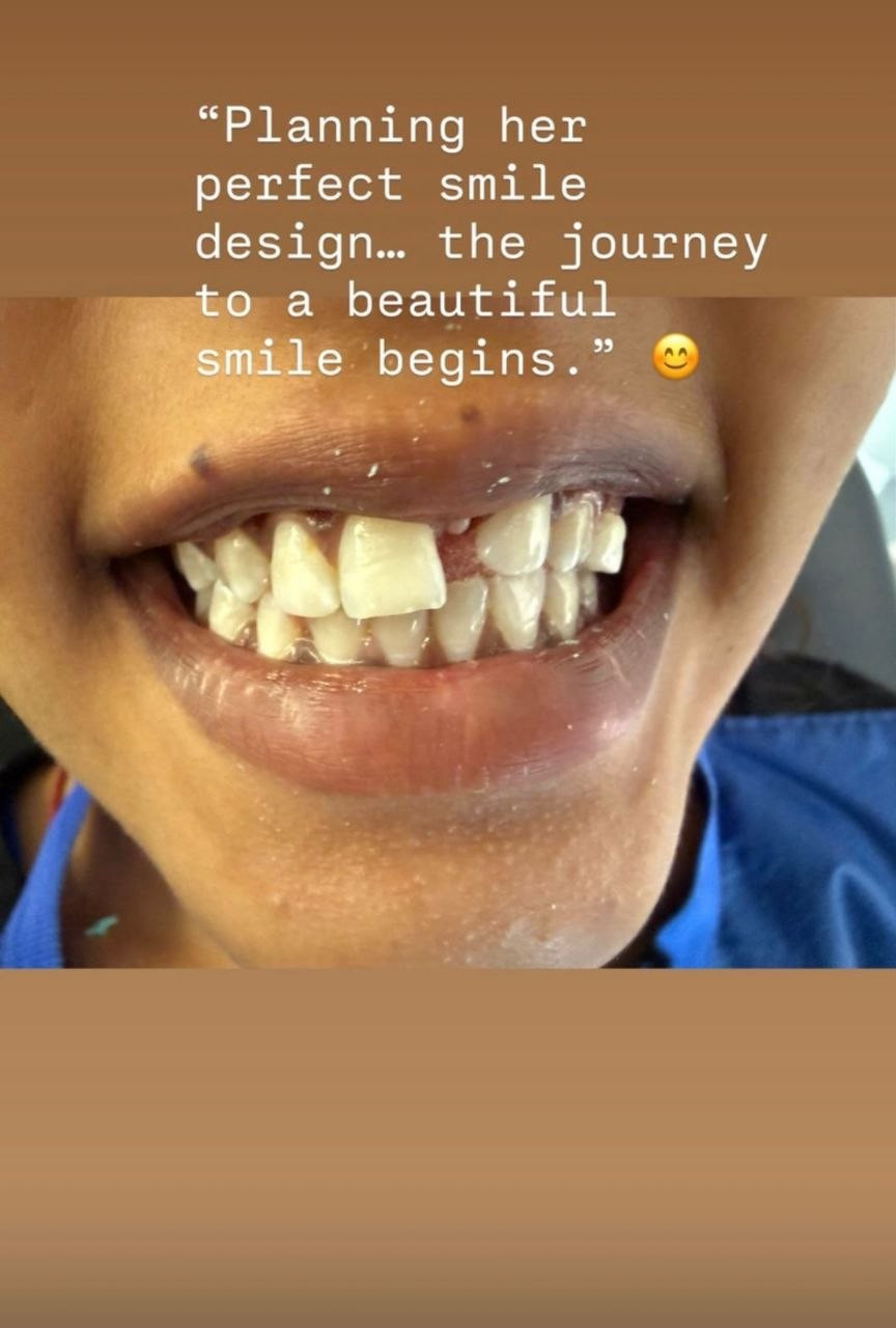 After implant