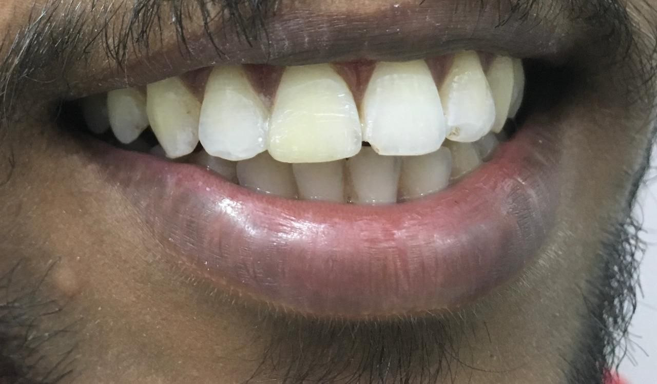 Yellow teeth before