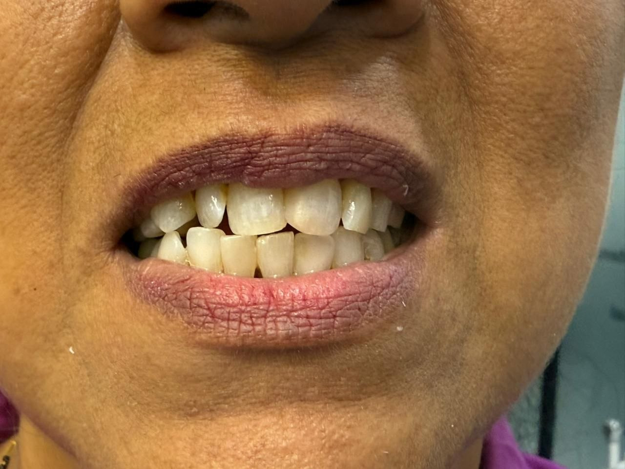 Crooked teeth before