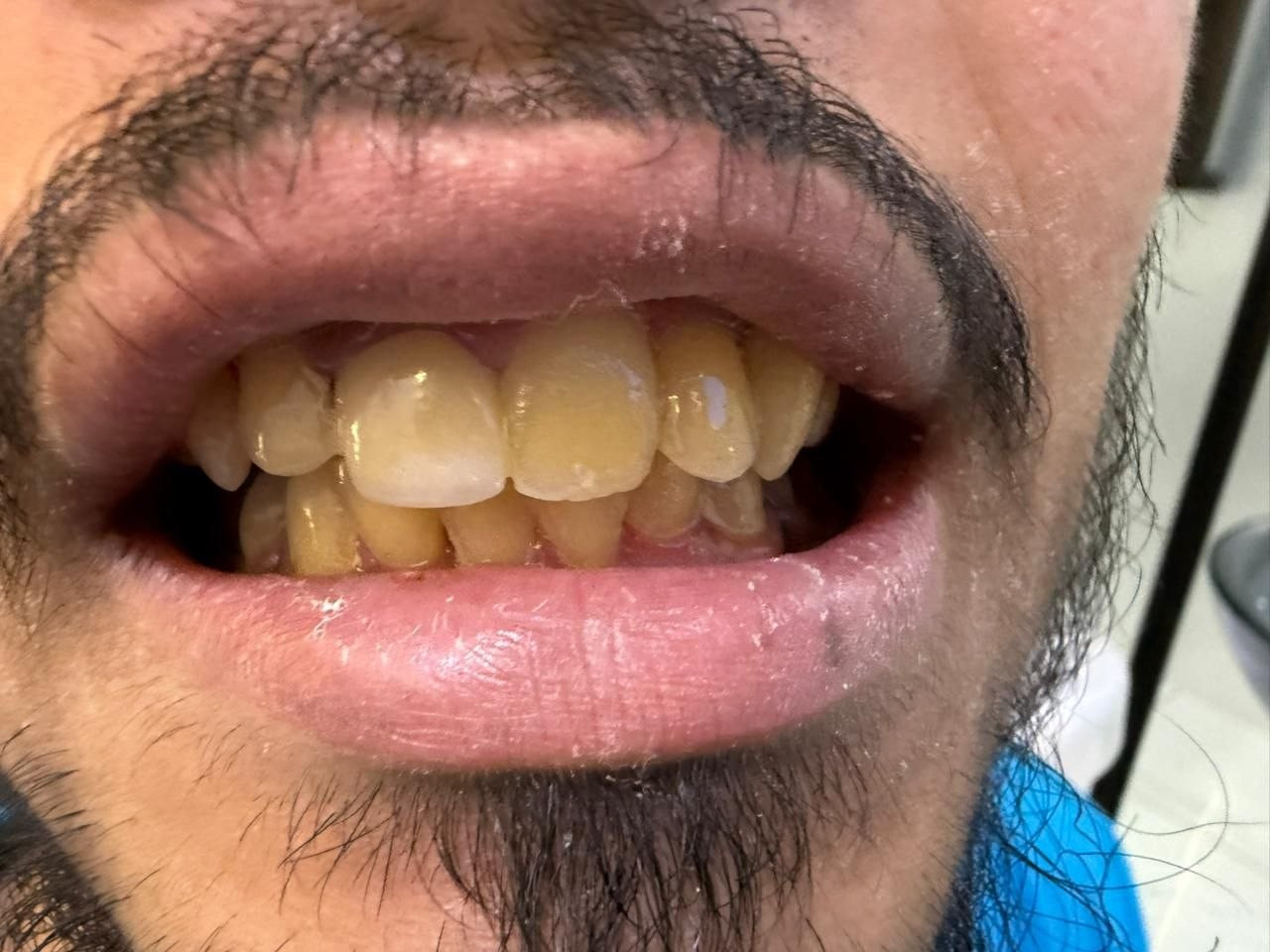 Crooked teeth before