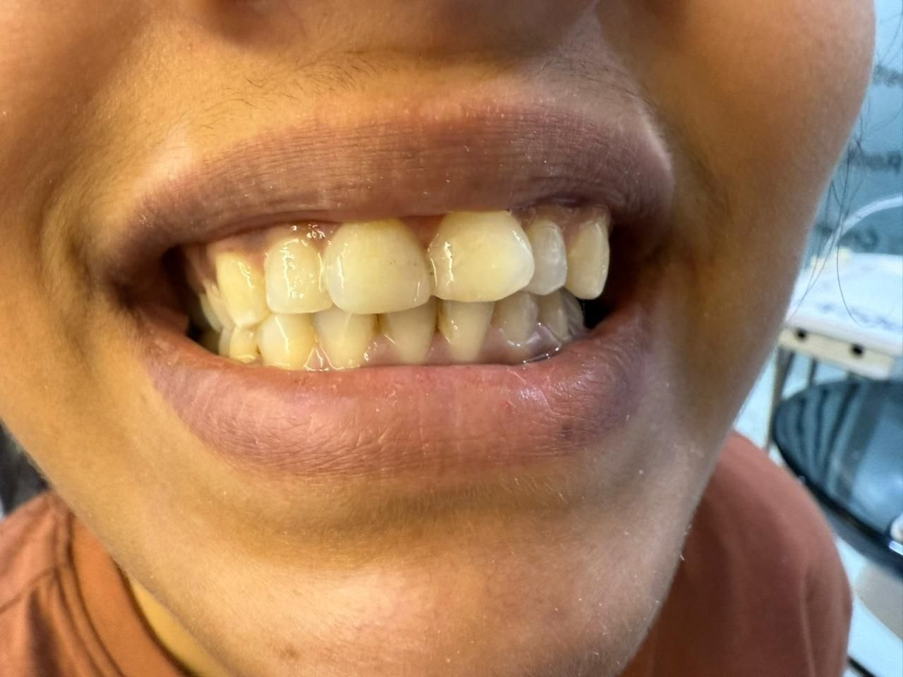 After implant
