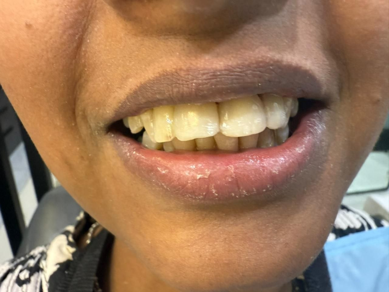 Before missing tooth