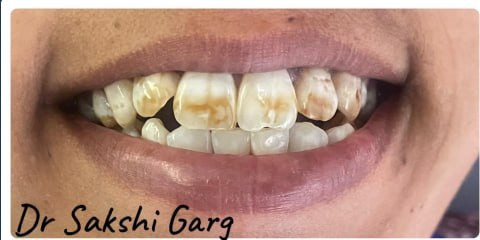White smile after
