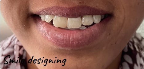 Yellow teeth before