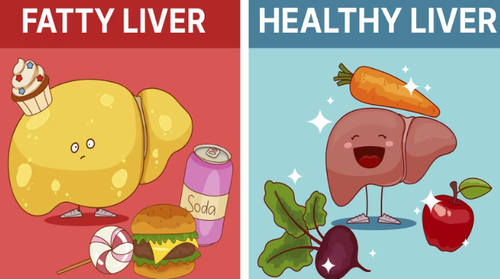 Fatty Liver Foods to Avoid What to Limit for Better Liver Health.png